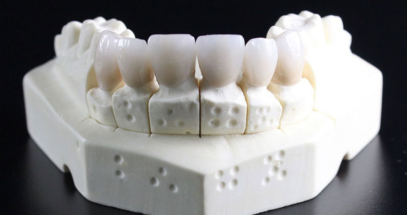 tipos-implantes-dentales