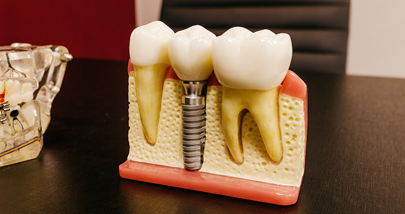 Diferencia-entre-implantes-dentales-atornillados-o-cementados