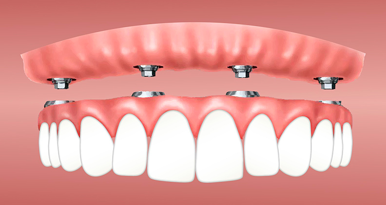 MOD-dentadura-fija-con-6-implantes