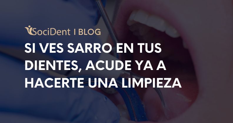 Si ves sarro, hazte urgentemente una limpieza dental